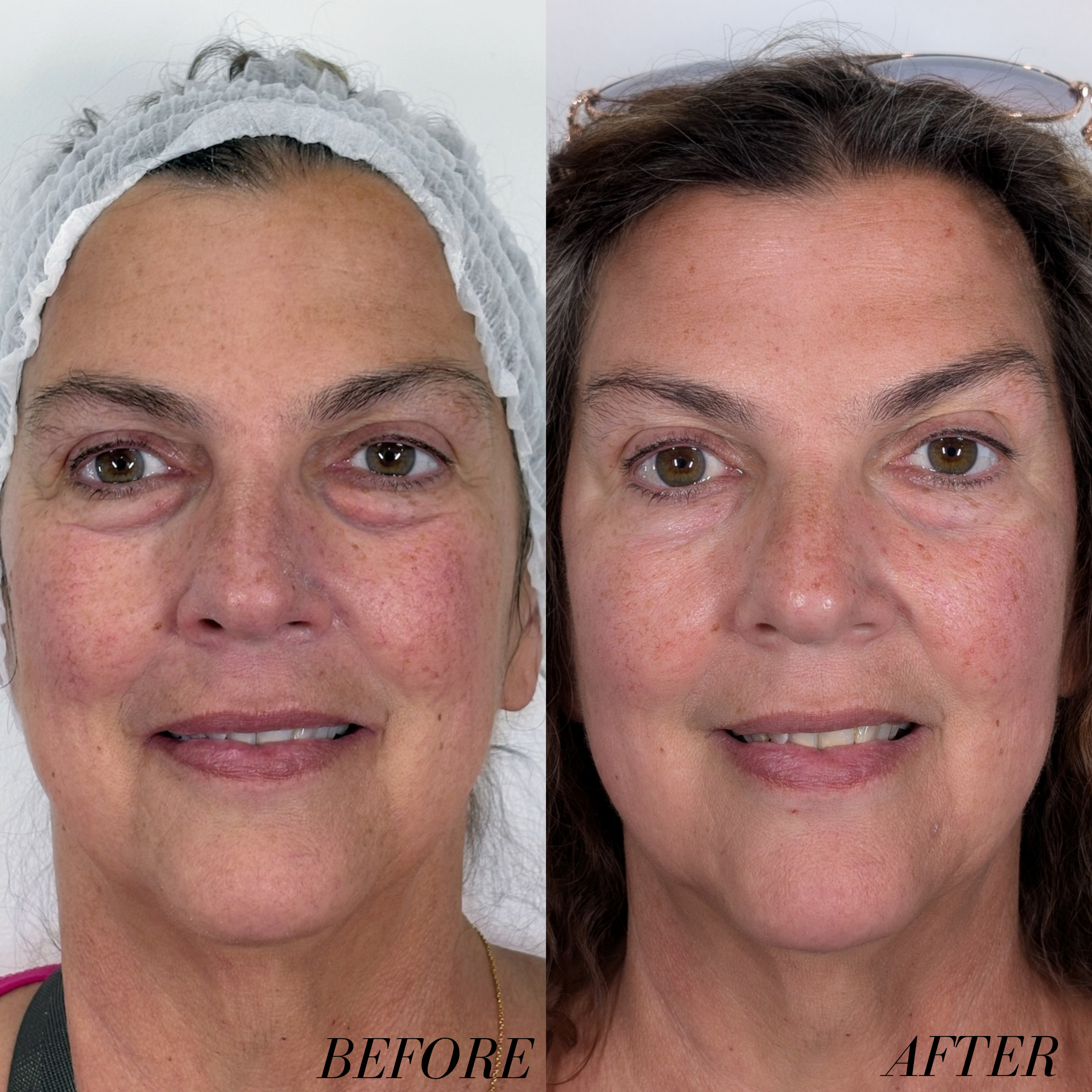 Revived Medical Aesthetics CO2 Laser Treatment After
