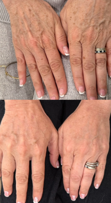 Revived Medical Aesthetics CO2 Laser Treatment Before