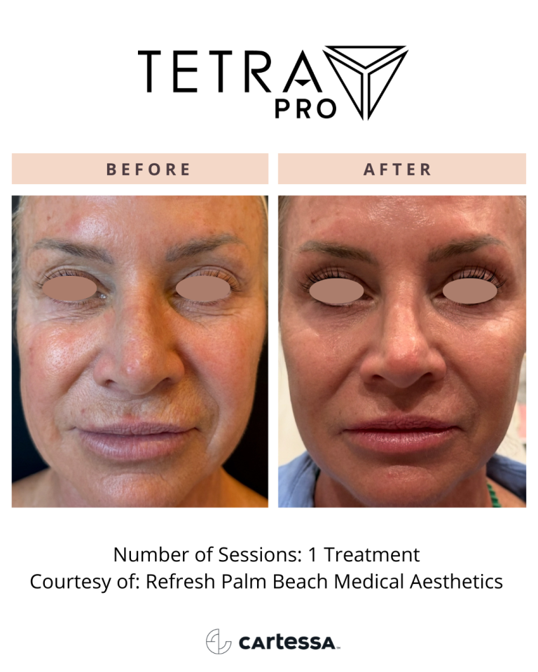 TetraPRO118175553142004