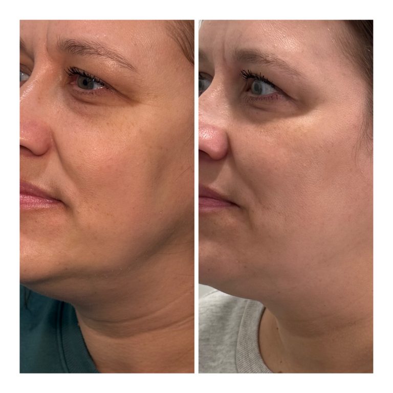 6 syringes of "versa" dermal filler