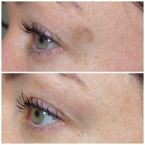 Sun spot removal with laser treatment