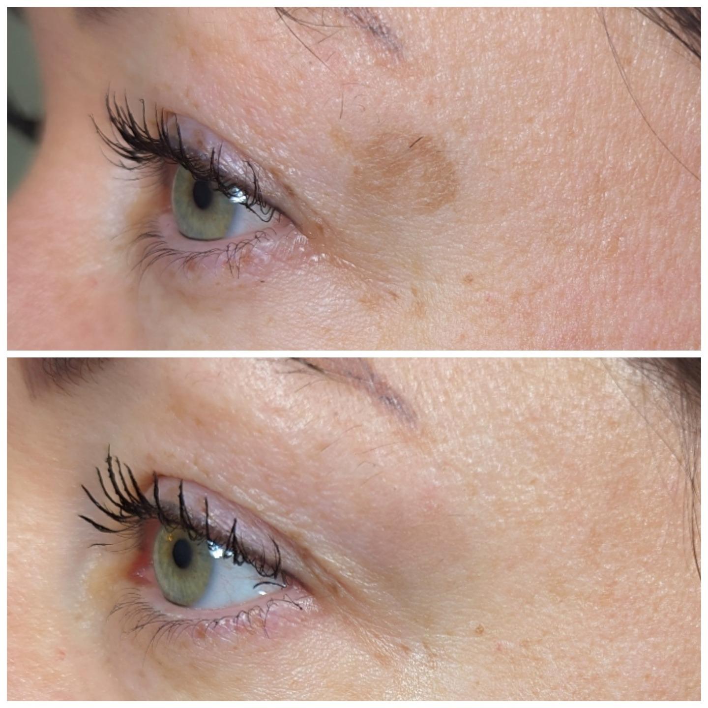 Revived Medical Aesthetics CO2 Laser Treatment Close-up