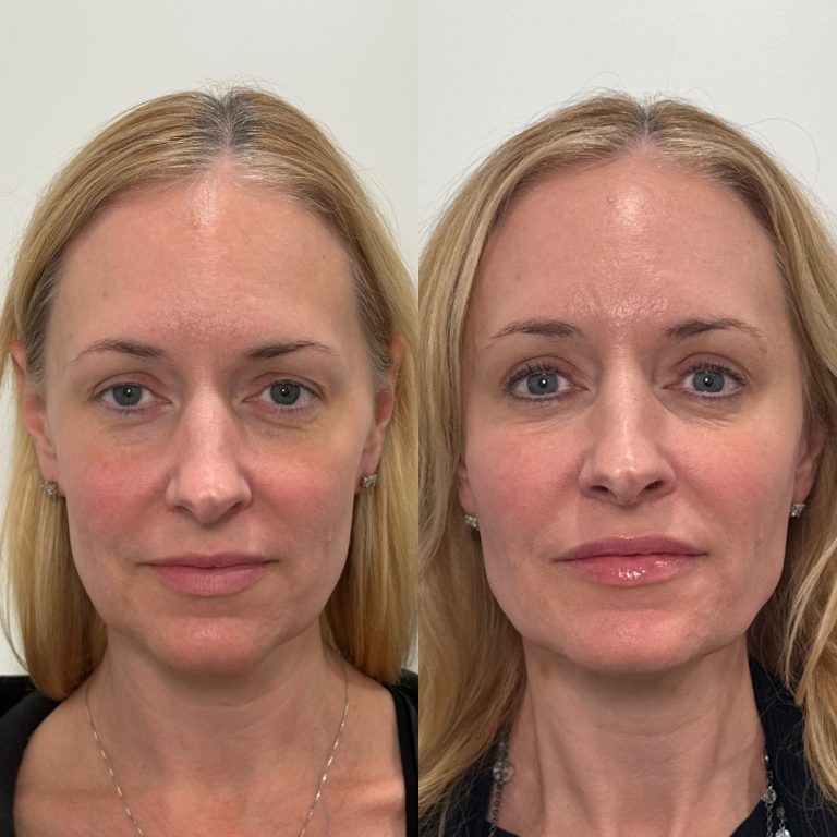 facial balancing before and after 3