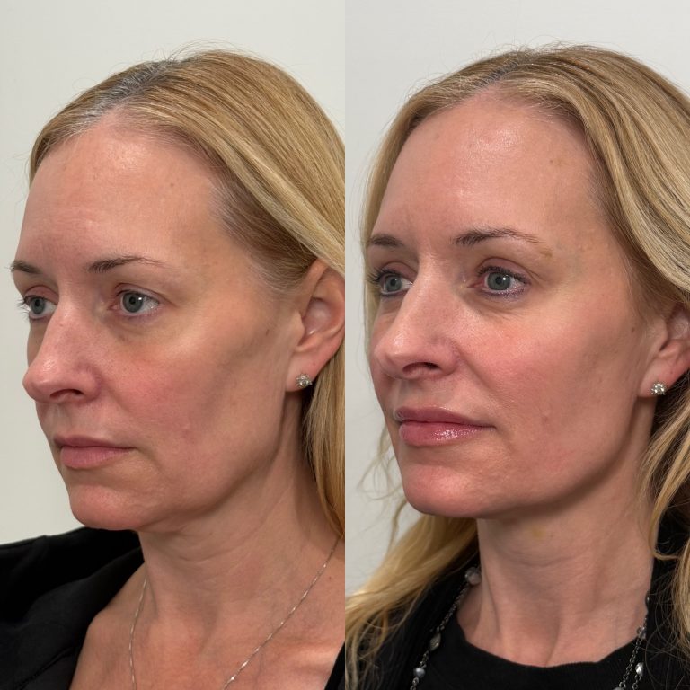 facial balancing before and after 2
