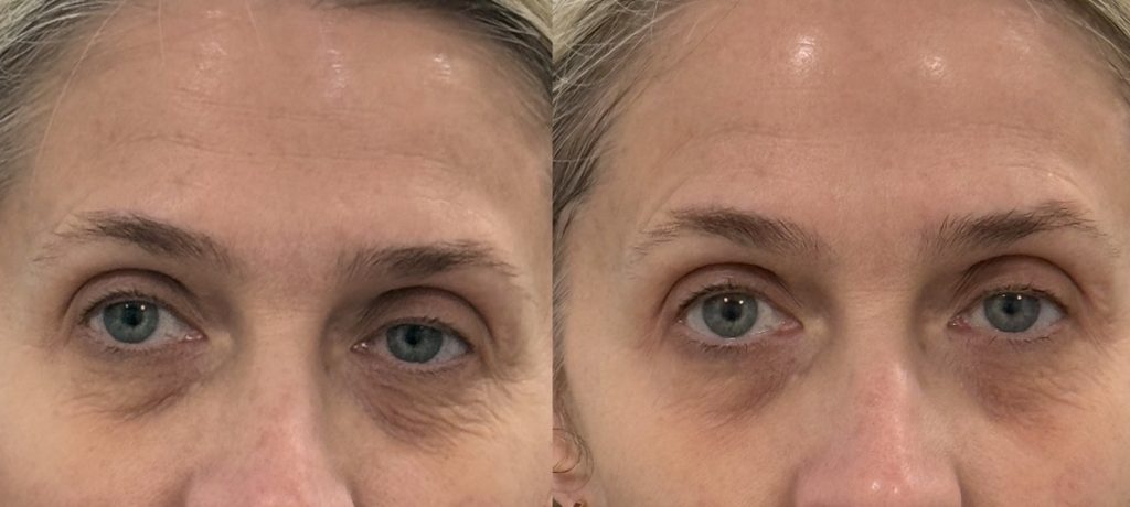 The Best Treatments for Aging Around the Eyes, Revived med spa Camp Hill, York, and Harrisburg PA