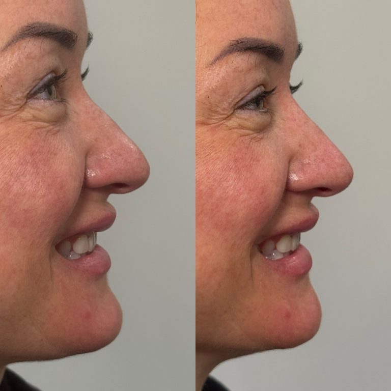 Nose Filler- Tara