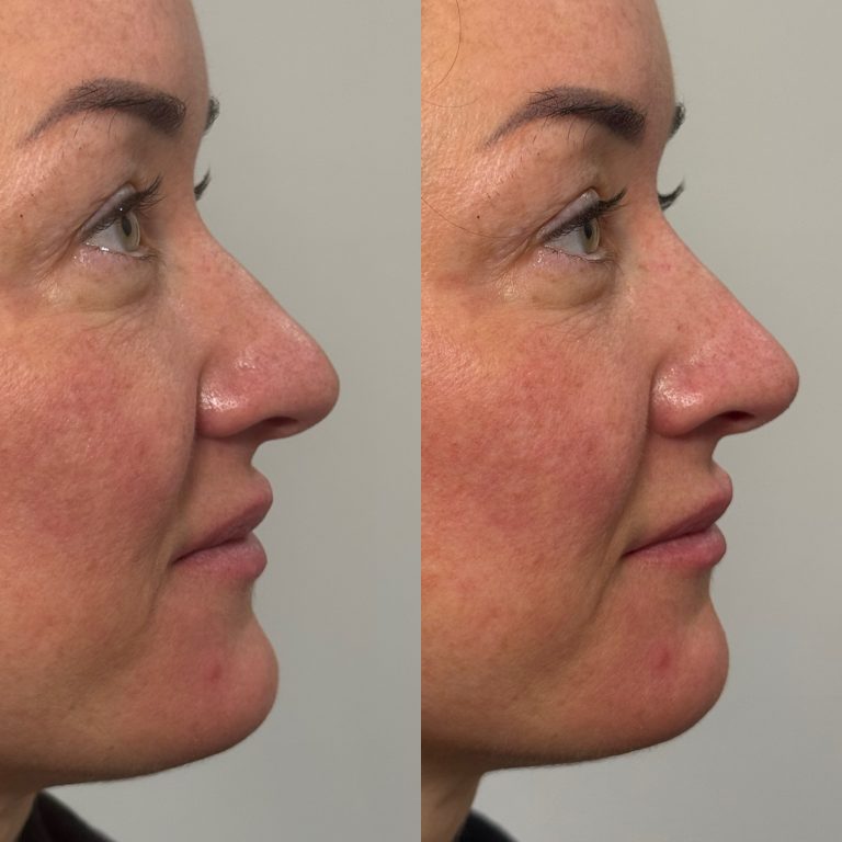 nose filler before and after