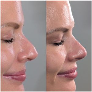 nose-filler-before-after
