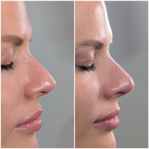 nose-filler