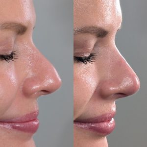 nose-filler-1
